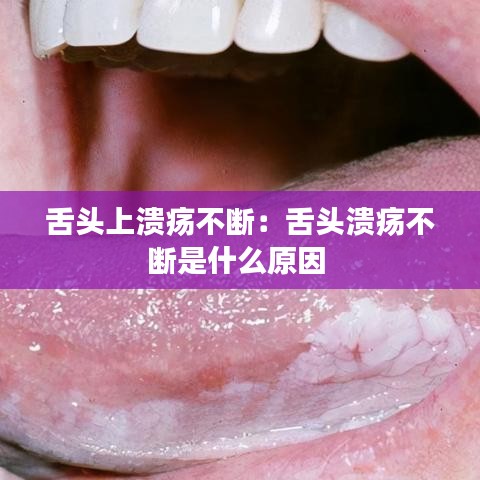 舌头上溃疡不断：舌头溃疡不断是什么原因 