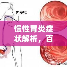 慢性胃炎症状解析，百度带你全面了解