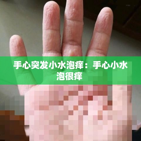 手心突发小水泡痒：手心小水泡很痒 