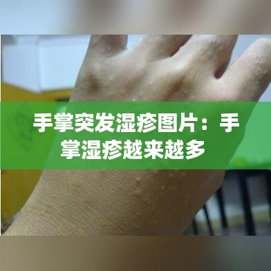 手掌突发湿疹图片：手掌湿疹越来越多 