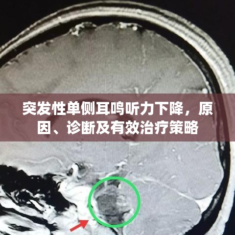 突发性单侧耳鸣听力下降，原因、诊断及有效治疗策略